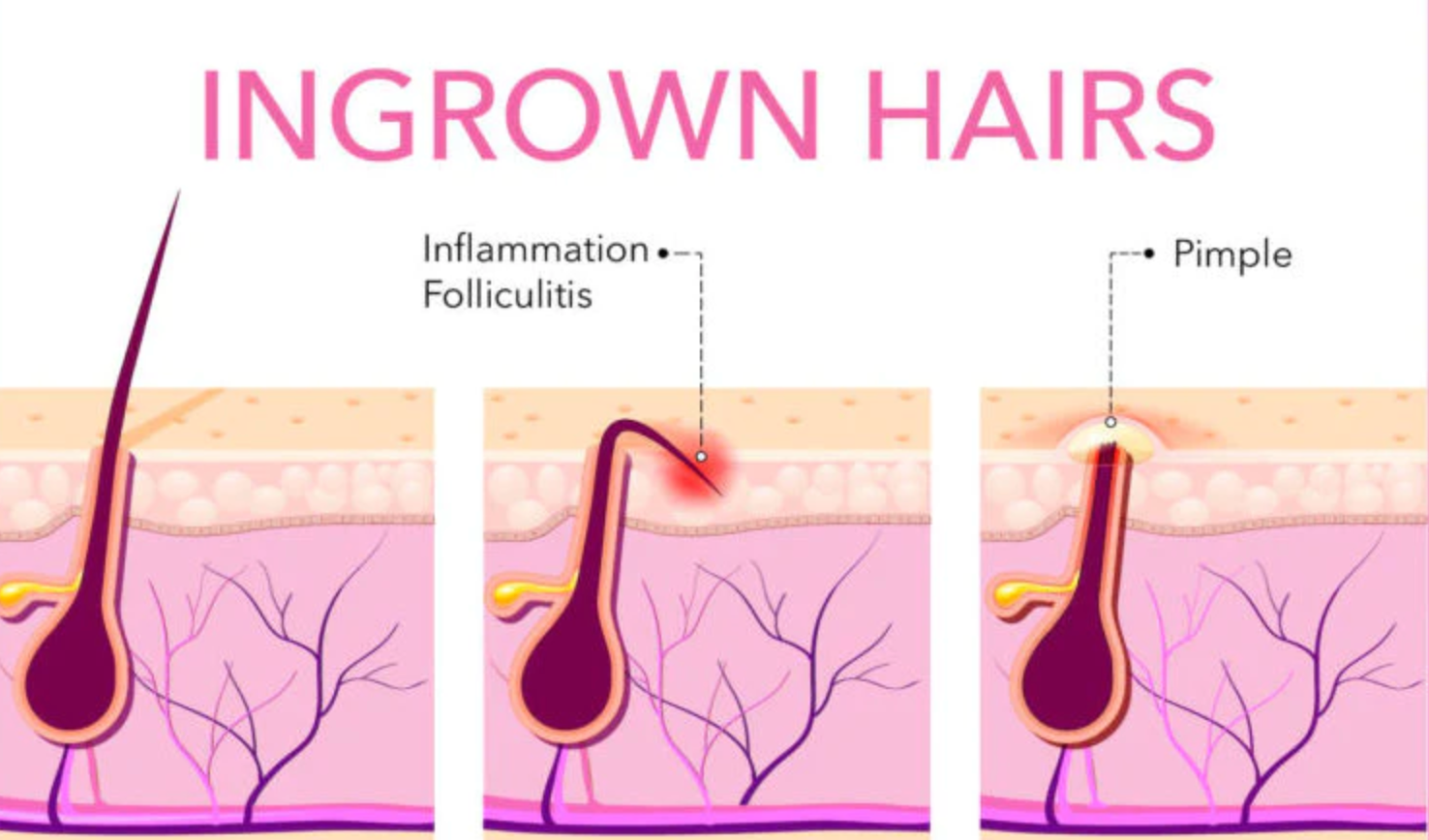 Ingrown Hairs