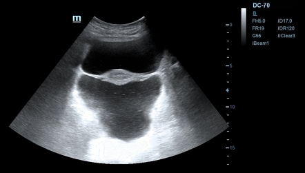 Free Fluid in Pelvis on Ultrasound